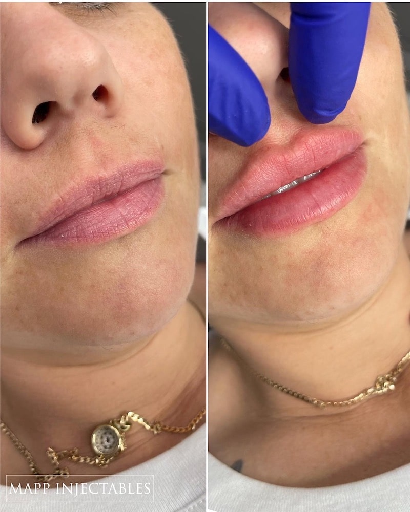 Lip Filler Photos High quality video and photos of our results